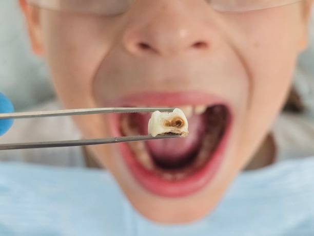 Best Emergency Tooth Extraction in Blackhawk, CA